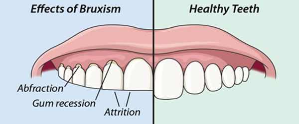 bruxism diagram