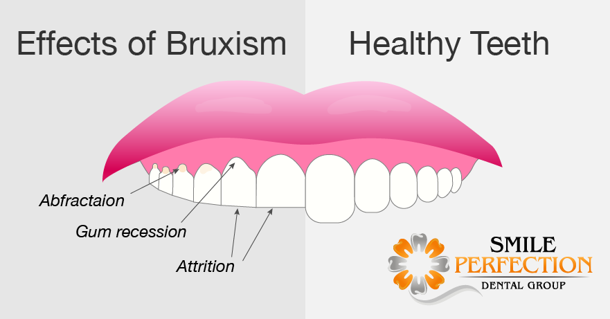 Bruxism